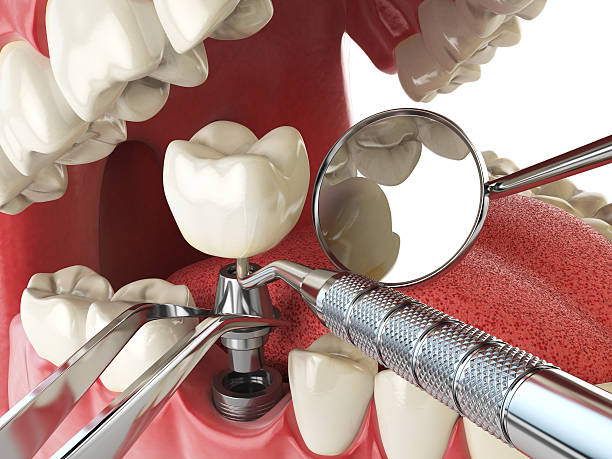 Best Emergency Dental Care for Broken or Chipped Teeth in Alliance, OH